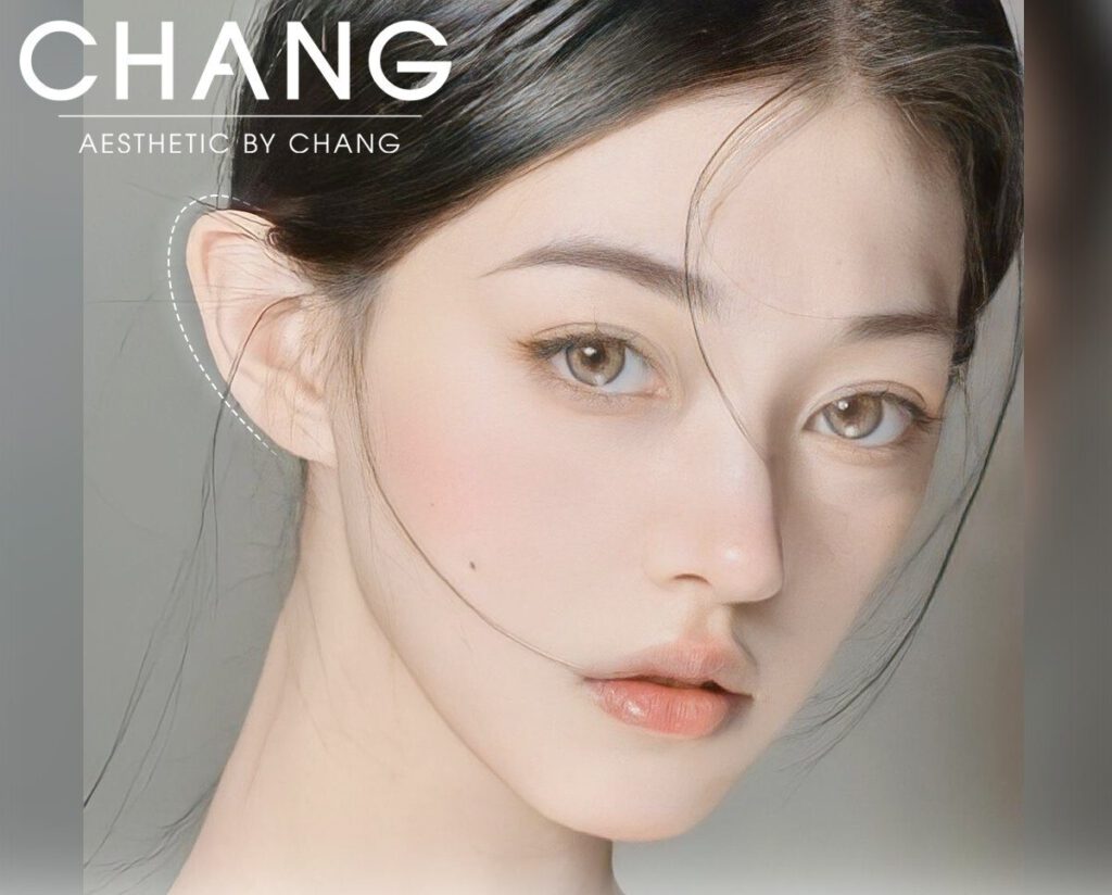 Tại hình tai vểnh