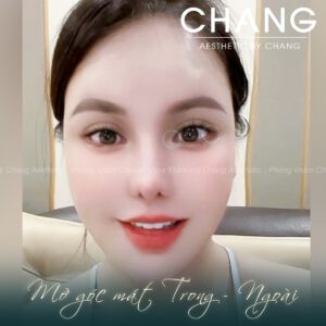 Sau khi thẩm mỹ mắt Trung Hoa