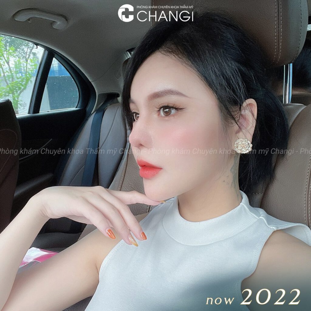 Sau thẩm mỹ mắt giọt lệ Trung Hoa, mắt đẹp long lanh quyến rũ
