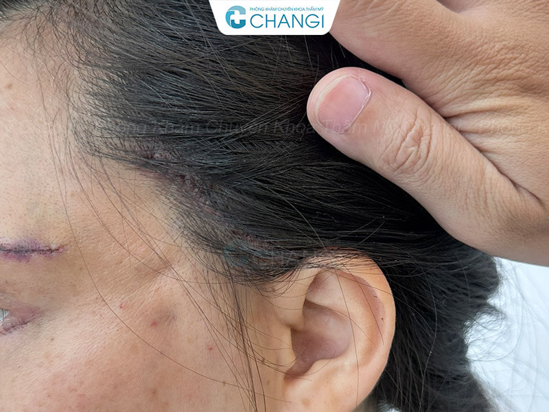 Vết thương sau khi <yoastmark class=