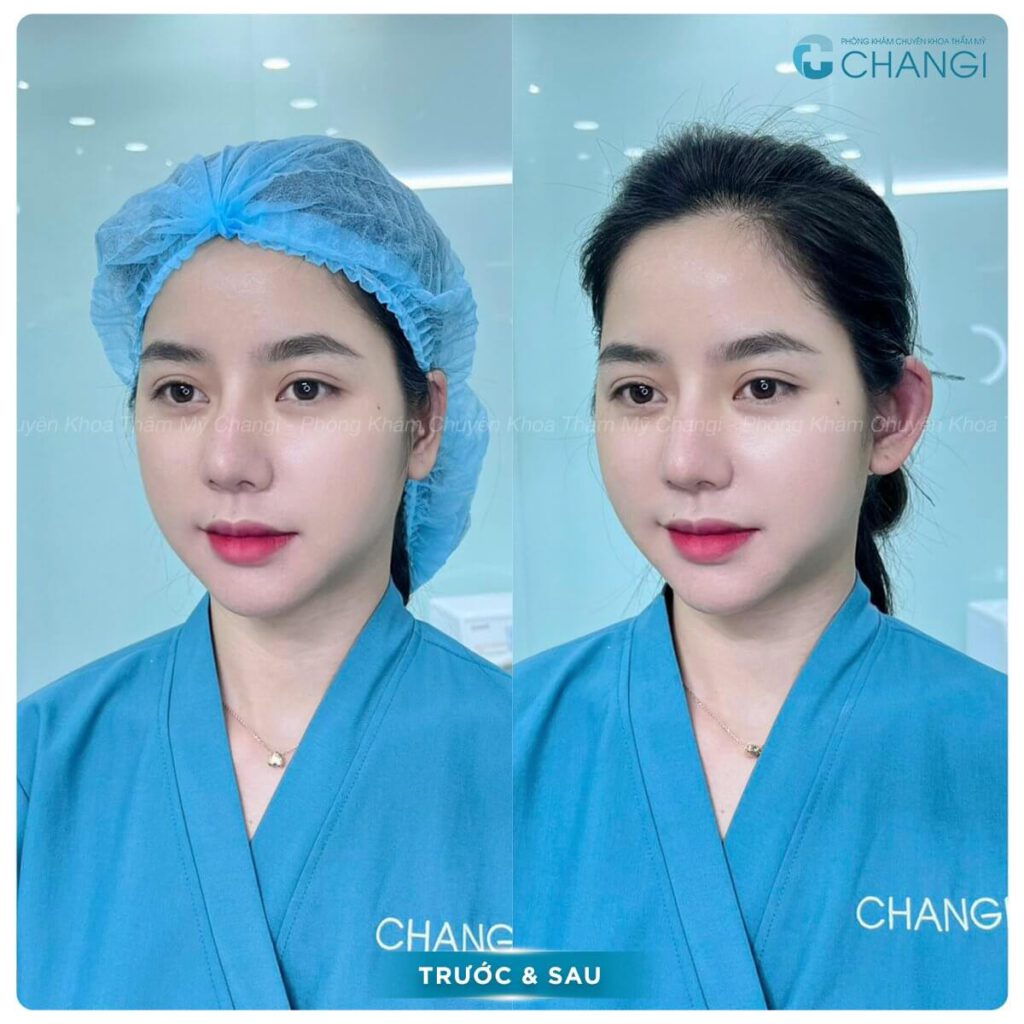 Kết quả sau thời gian phẫu thuật tạo hình tai vểnh