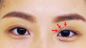 Xuất hiện nhiều nếp mí sau khi phẫu thuật cắt mí mắt